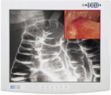 NDS Surgical Imaging 90R0015 Radiance Series 19 High-Definition, Multi-Modality Imaging LCD Display, Pixel Pitch 0.294 mm, Resolution (H x W) 1280 x 1024 (SXGA), Luminance 450 cd/m2, Contrast Ratio 650:1, Aspect Ratio 5:4, Number of Colors 16.8 Million, Color Gamut 100% (SMPTE 296M, HD Standard), Viewing Angle 178, Response 10-16 ms (90R-0015 90R 0015)
