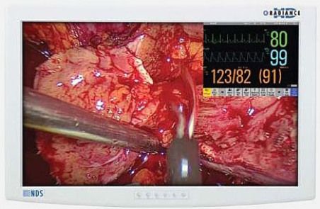 NDS Surgical Imaging 90R0020 Radiance Series 26 High-Definition, Multi-Modality Imaging LCD Display, Pixel Pitch 0.287 mm, Resolution (H x W) 1920 x 1200 (WUXGA), Luminance 500 cd/m2, Contrast Ratio 800:1, Aspect Ratio 16:10, Number of Colors 16.8 Million, Viewing Angle 178, Response 5-12 ms, Color Gamut 100% (SMPTE 296M, HD Standard) (90R-0020 90R 0020)